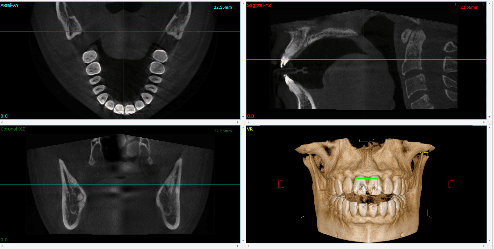 DICOM dental tomografi görüntüsü